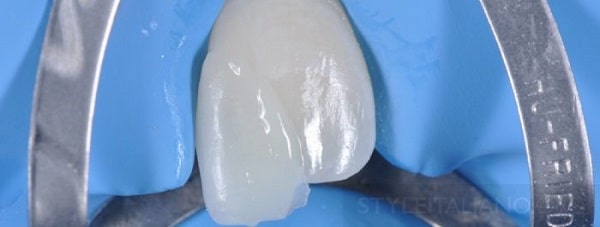 Hình 14. Đặt veneer chip