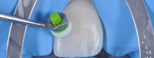 Hình 15. Sử dụng miếng đệm Optrasculpt