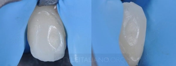 Hình 16. Đặt đê cao su cho quá trình dán các veneer sứ còn lại