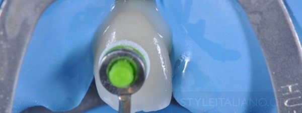 Hình 17. Quy trình tương tự để dán veneer trên răng 12