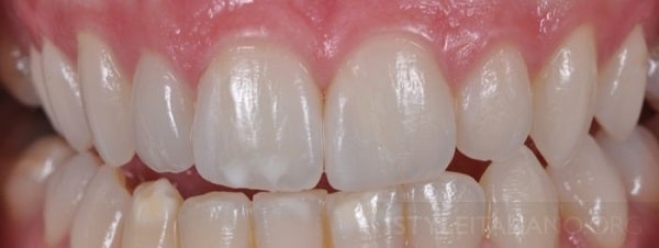 Hình 18. Sự kết hợp của cả 2 phục hình