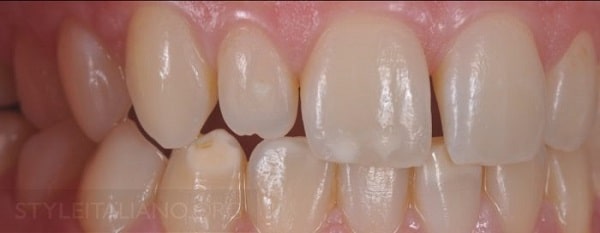 Hình 3. Kiểm tra khớp cắn