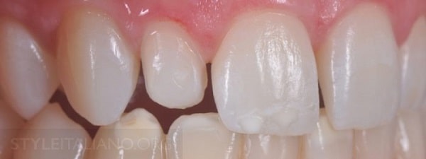 Hình 9. Phương pháp không sửa soạn được chọn cho răng số 11 và 21