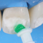 Icon điều trị đốm trắng